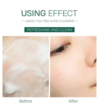 LAlKOU Tea Tree Cleanser Gentle Acne Treatment Blackhead Cleaner Shrink Pore Deep Clean Oil Control Moisturizing Face Skin Care